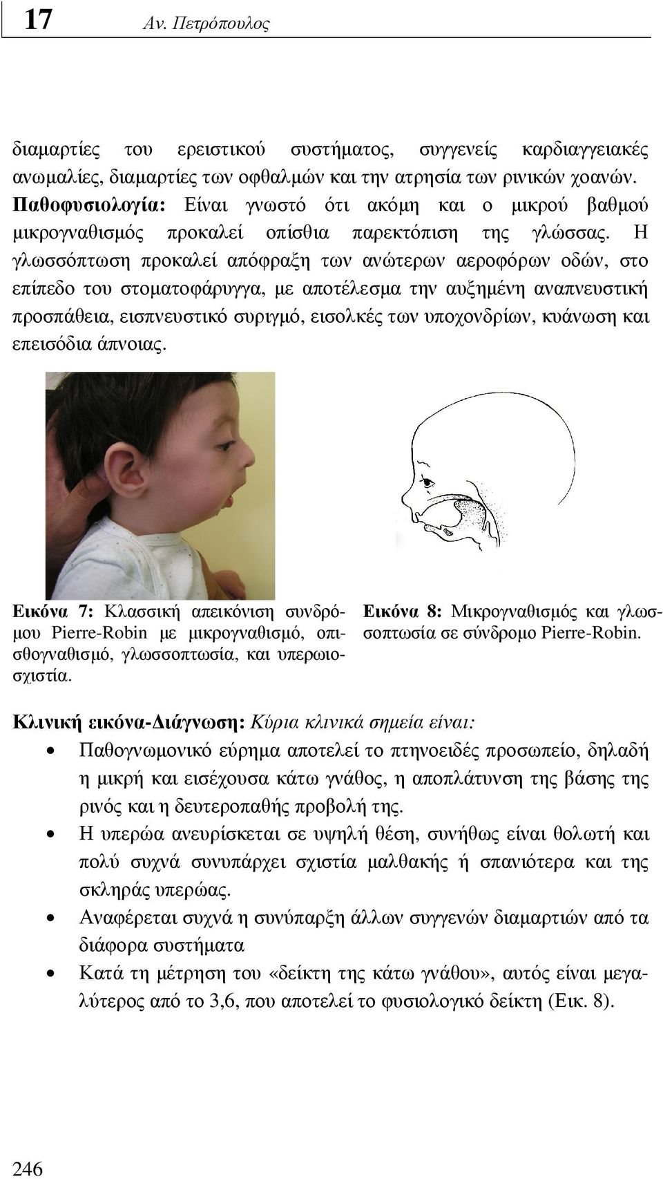 Η γλωσσόπτωση προκαλεί απόφραξη των ανώτερων αεροφόρων οδών, στο επίπεδο του στοµατοφάρυγγα, µε αποτέλεσµα την αυξηµένη αναπνευστική προσπάθεια, εισπνευστικό συριγµό, εισολκές των υποχονδρίων,