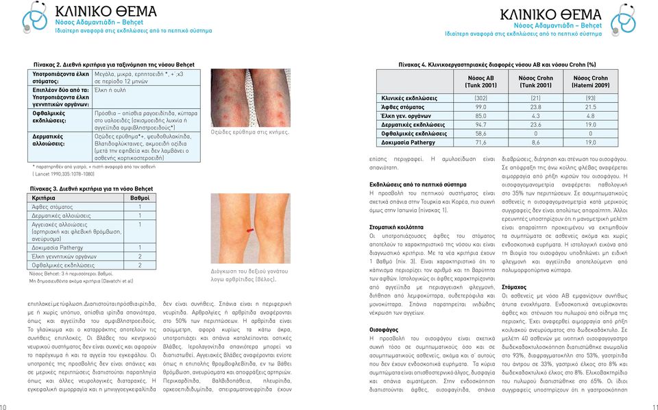 Διεθνή κριτήρια για τη νόσο Behçet Κριτήρια Μεγάλα, μικρά, ερπητοειδή *, + ;x3 σε περίοδο 12 μηνών Έλκη ή ουλή Βαθμοί Άφθες στόματος 1 Δερματικές αλλοιώσεις 1 Αγγειακές αλλοιώσεις 1 (αρτηριακή και