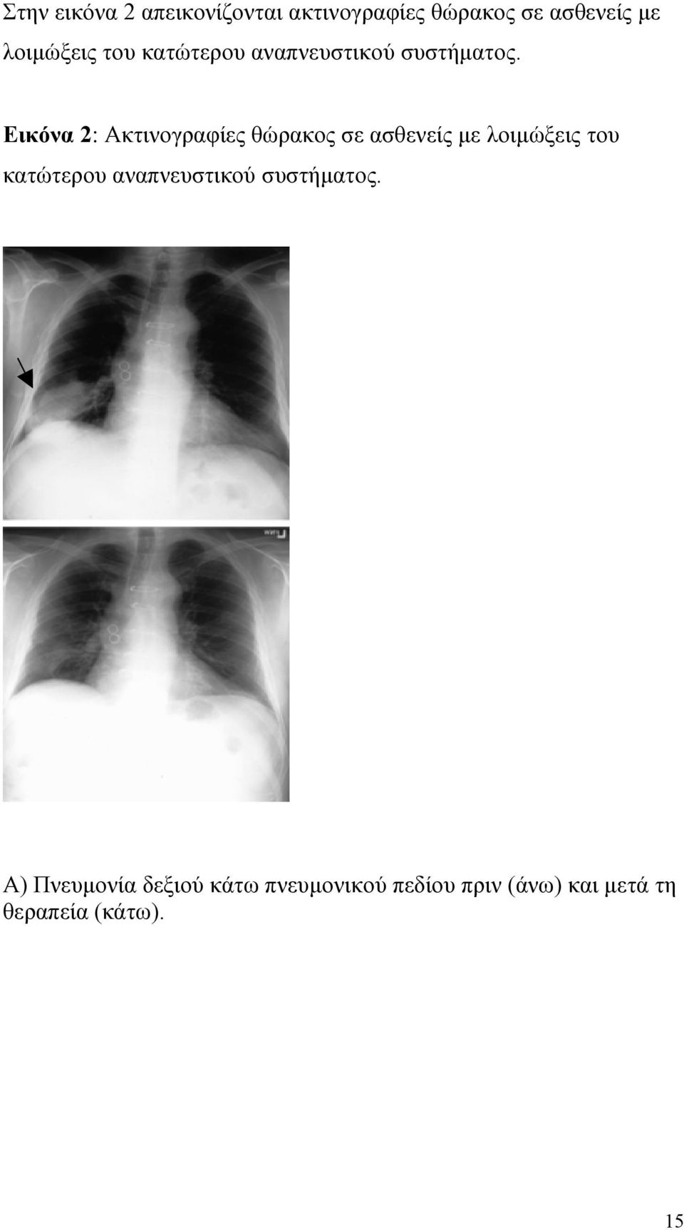 Εικόνα 2 Ακτινογραφίες θώρακος σε ασθενείς με  Α) Πνευμονία δεξιού κάτω