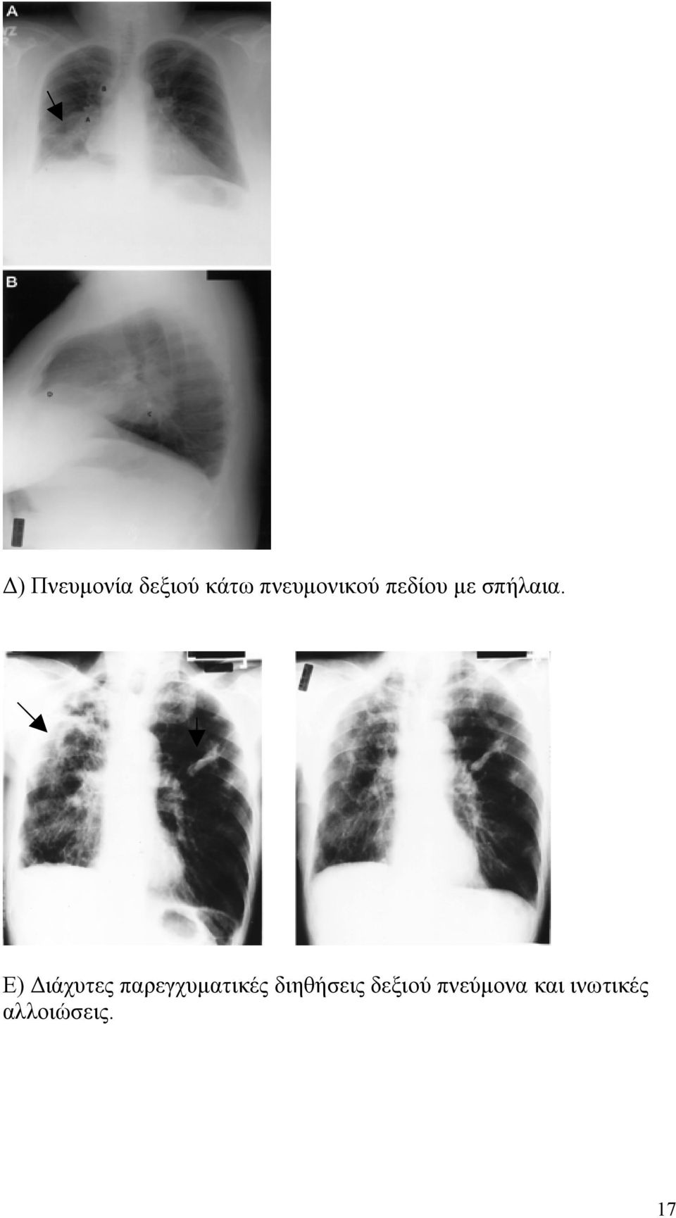 Ε) Διάχυτες παρεγχυματικές