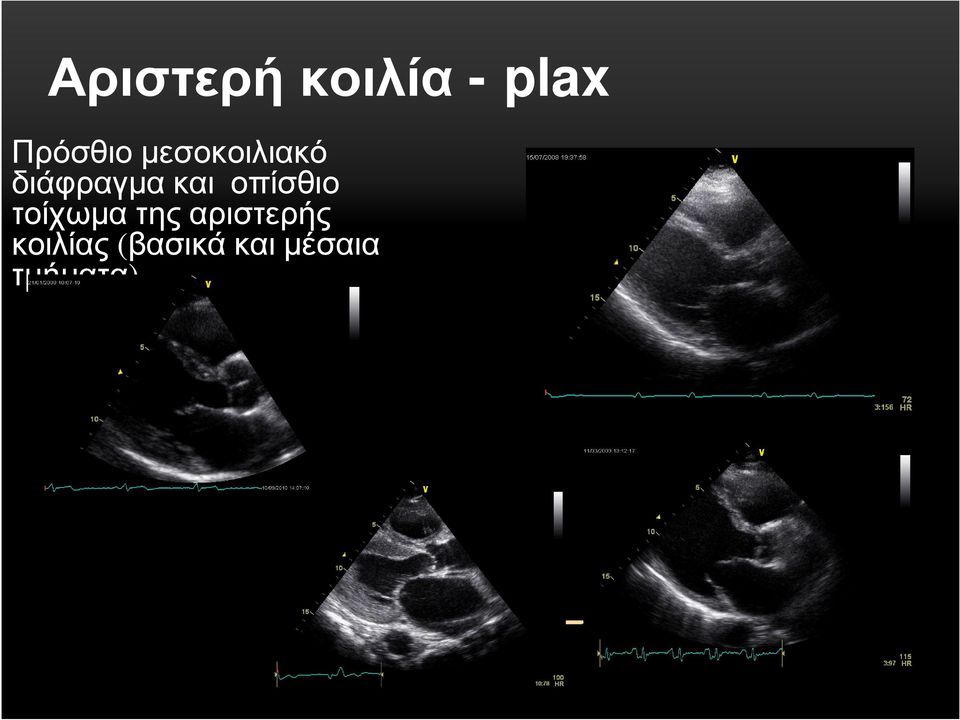 οπίσθιο τοίχωµα της αριστερής