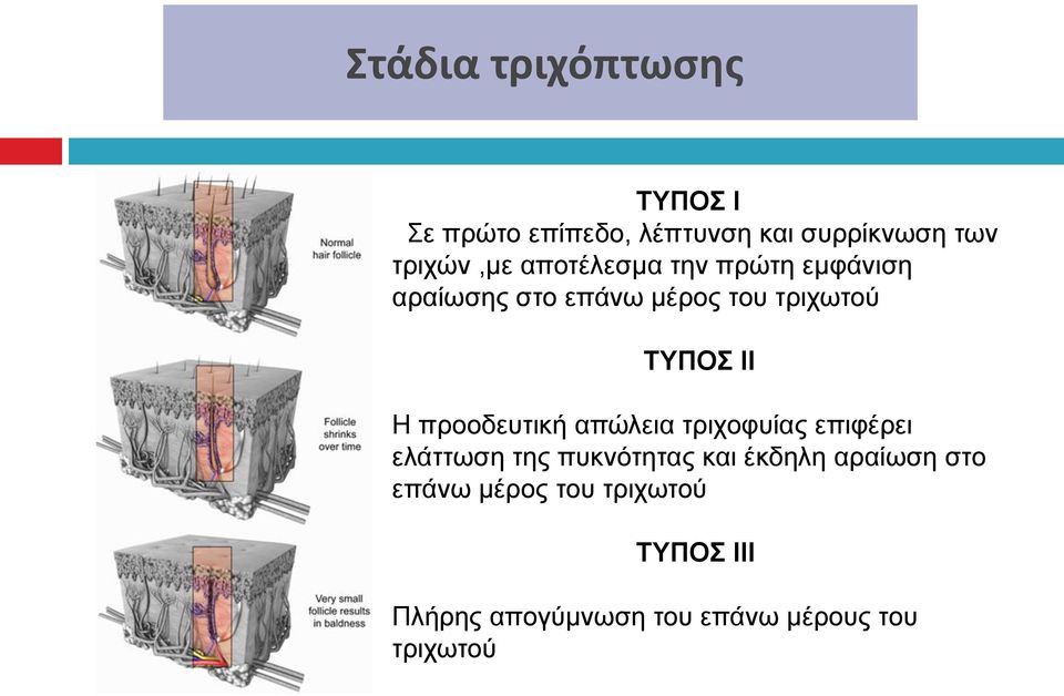 προοδευτική απώλεια τριχοφυίας επιφέρει ελάττωση της πυκνότητας και έκδηλη αραίωση