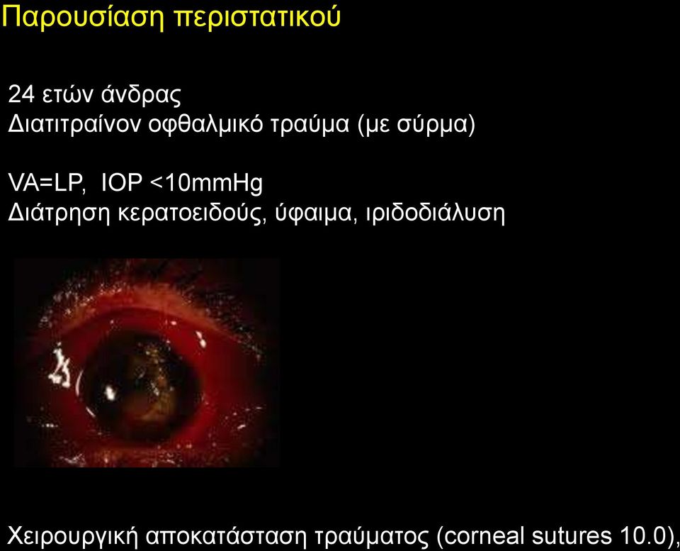 IOP <10mmHg Γηάηξεζε θεξαηνεηδνύο, ύθαηκα,