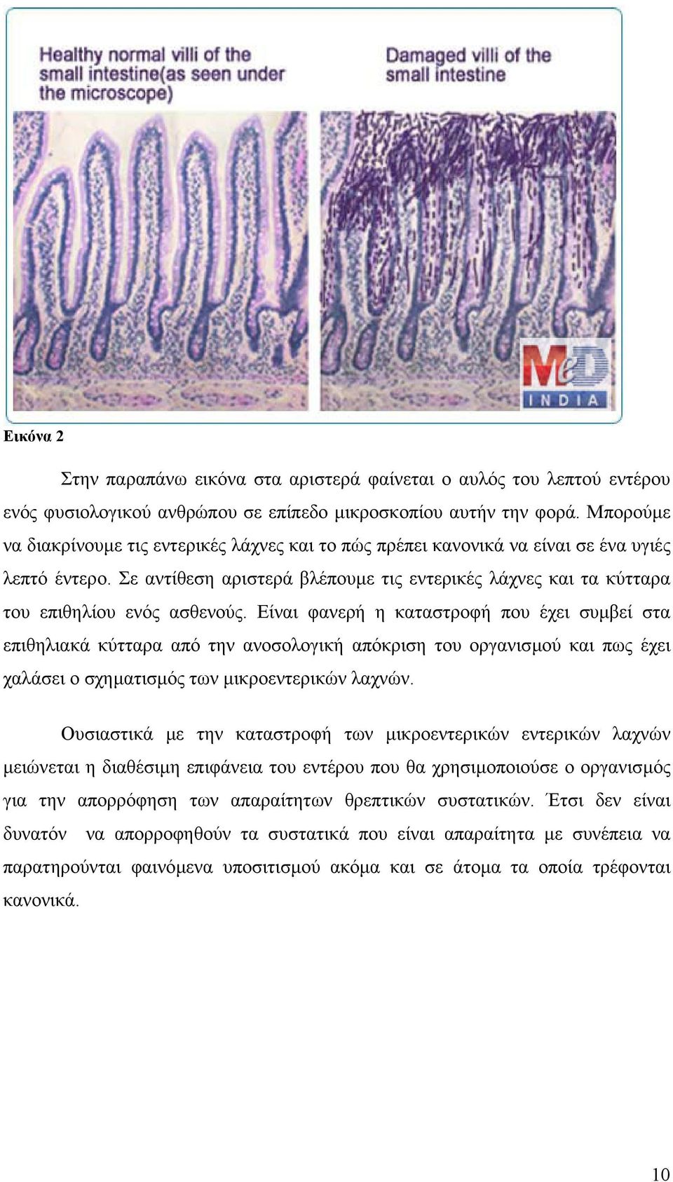 Σε αντίθεση αριστερά βλέπουµε τις εντερικές λάχνες και τα κύτταρα του επιθηλίου ενός ασθενούς.