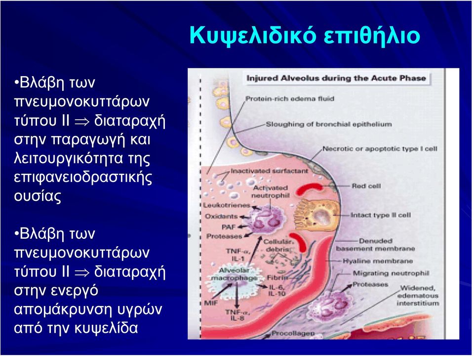 επιφανειοδραστικής ουσίας Βλάβη των πνευμονοκυττάρων