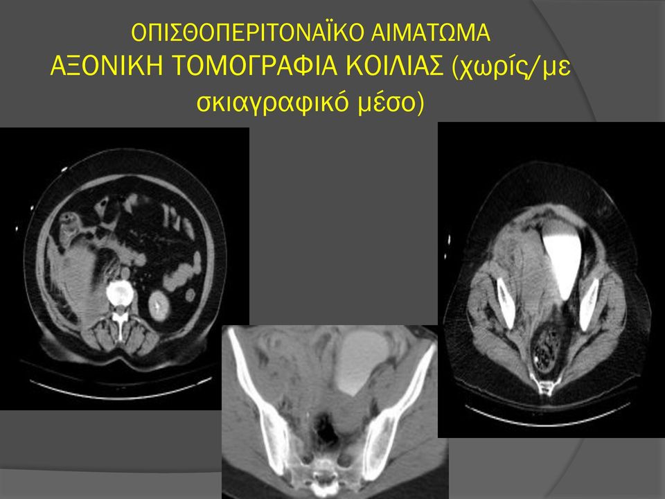 ΤΟΜΟΓΡΑΦΙΑ ΚΟΙΛΙΑΣ