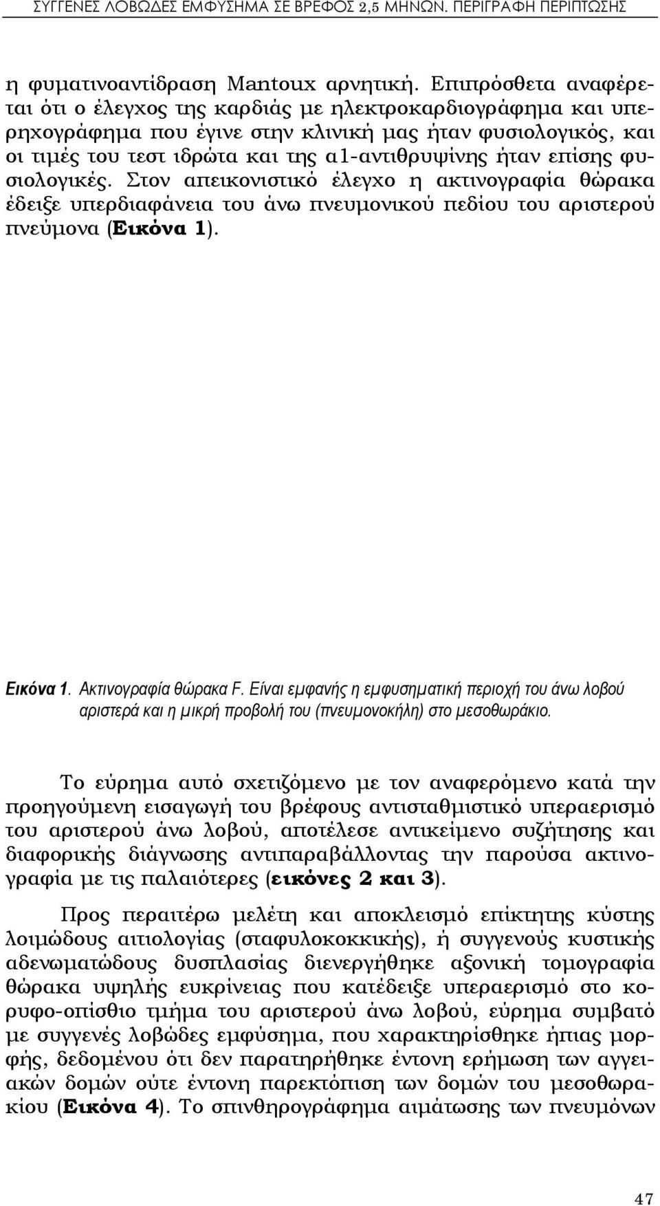 επίσης φυσιολογικές. Στον απεικονιστικό έλεγχο η ακτινογραφία θώρακα έδειξε υπερδιαφάνεια του άνω πνευμονικού πεδίου του αριστερού πνεύμονα (Εικόνα 1). Εικόνα 1. Ακτινογραφία θώρακα F.