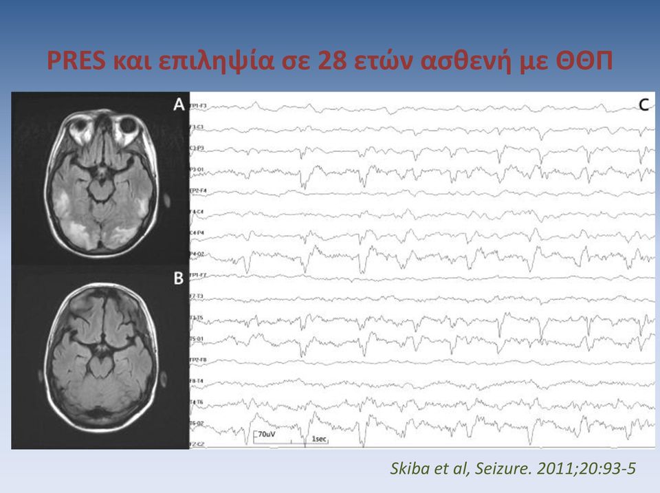 με ΘΘΠ Skiba et al,