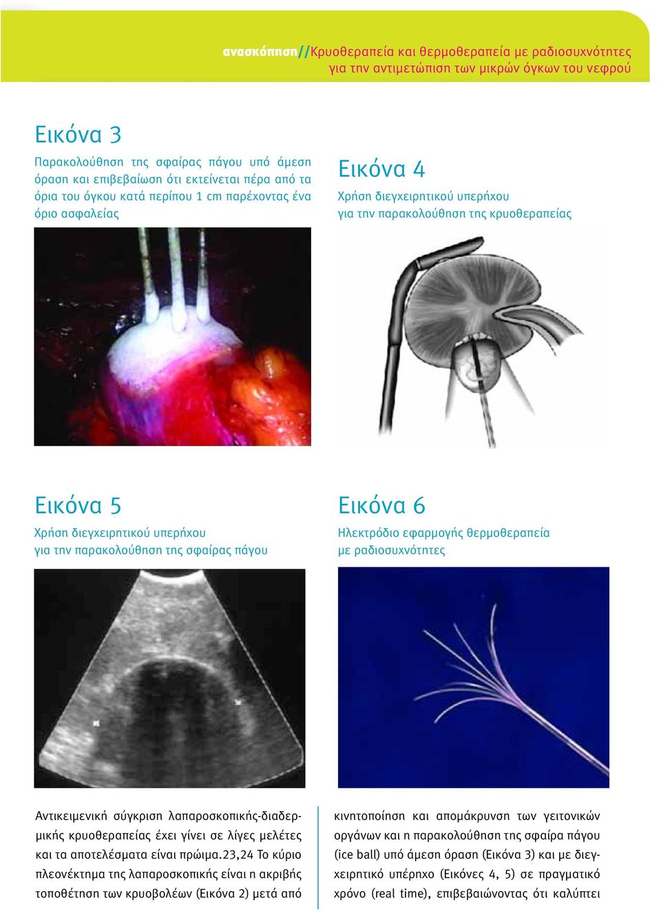 την παρακολούθηση της σφαίρας πάγου Εικόνα 6 Ηλεκτρόδιο εφαρµογής θερµοθεραπεία µε ραδιοσυχνότητες Αντικειµενική σύγκριση λαπαροσκοπικής-διαδερ- µικής κρυοθεραπείας έχει γίνει σε λίγες µελέτες και τα