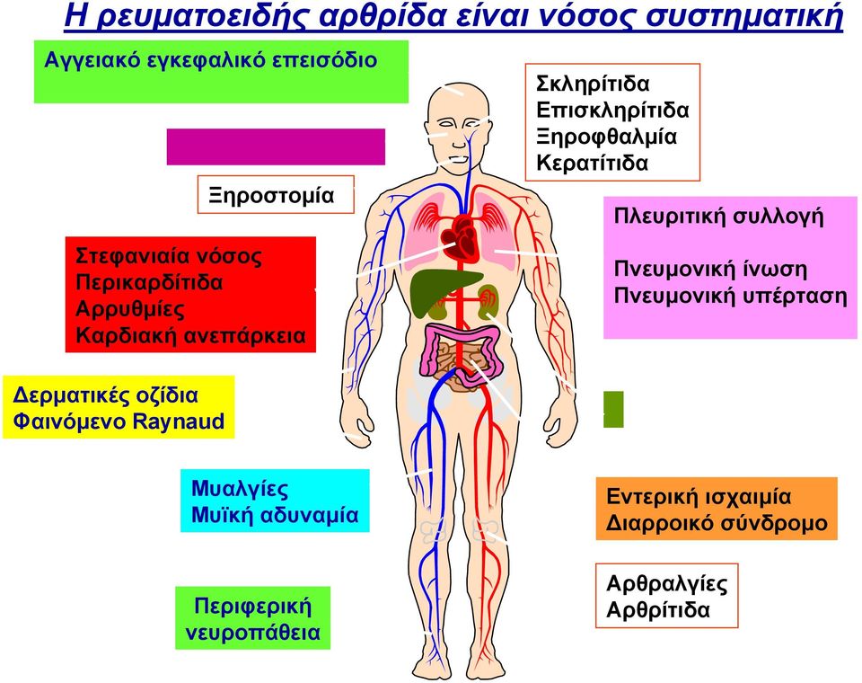 Σκληρίτιδα Επισκληρίτιδα Ξηροφθαλμία Κερατίτιδα Πλευριτική συλλογή Πνευμονική ίνωση Πνευμονική