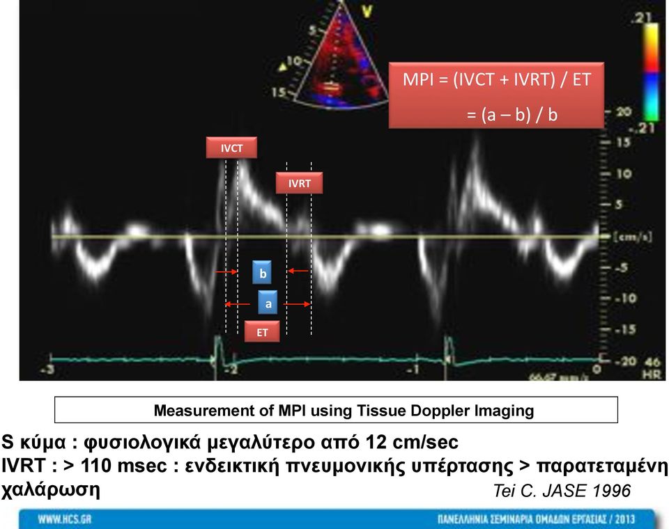 φυσιολογικά µεγαλύτερο από 12 cm/sec IVRT : > 110 msec :