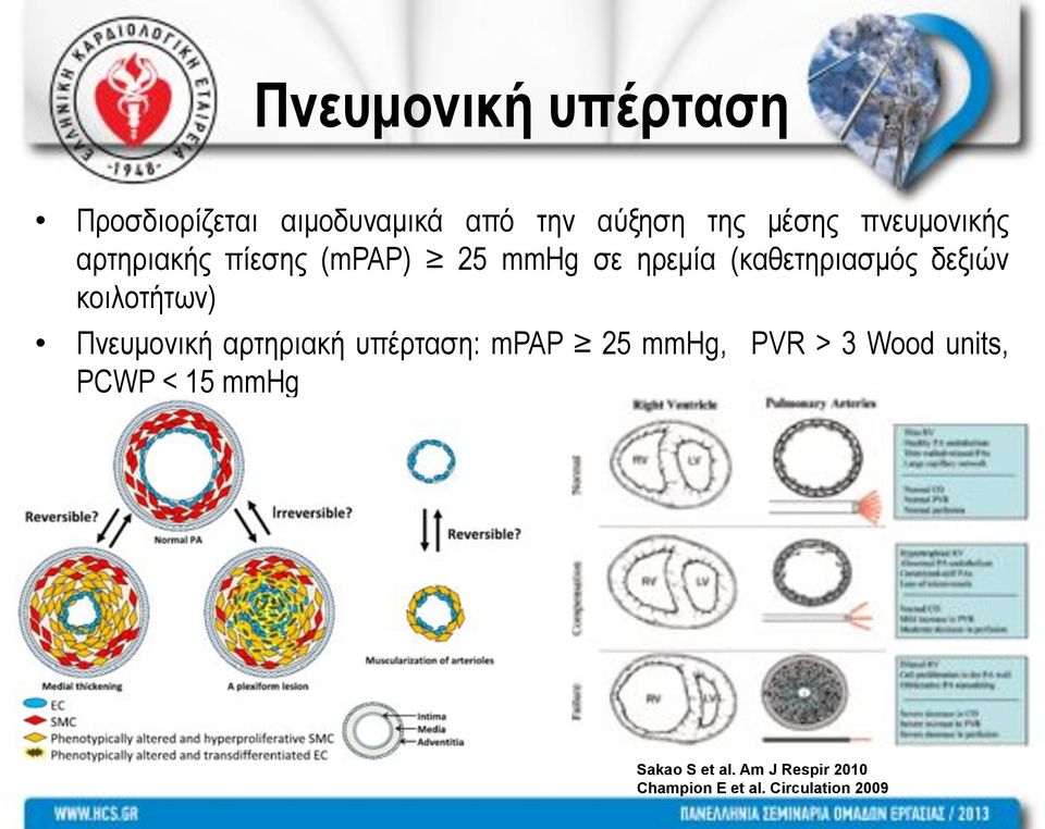 κοιλοτήτων) Πνευµονική αρτηριακή υπέρταση: mpap 25 mmhg, PVR > 3 Wood units,