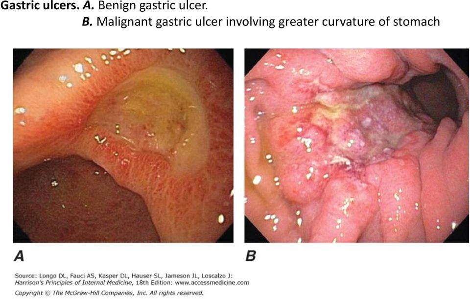 Malignant gastric ulcer