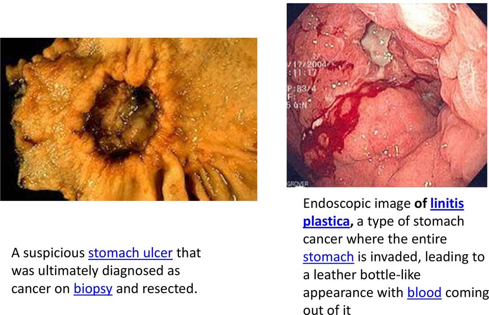 Endoscopic image of linitis plastica, a type of stomach cancer