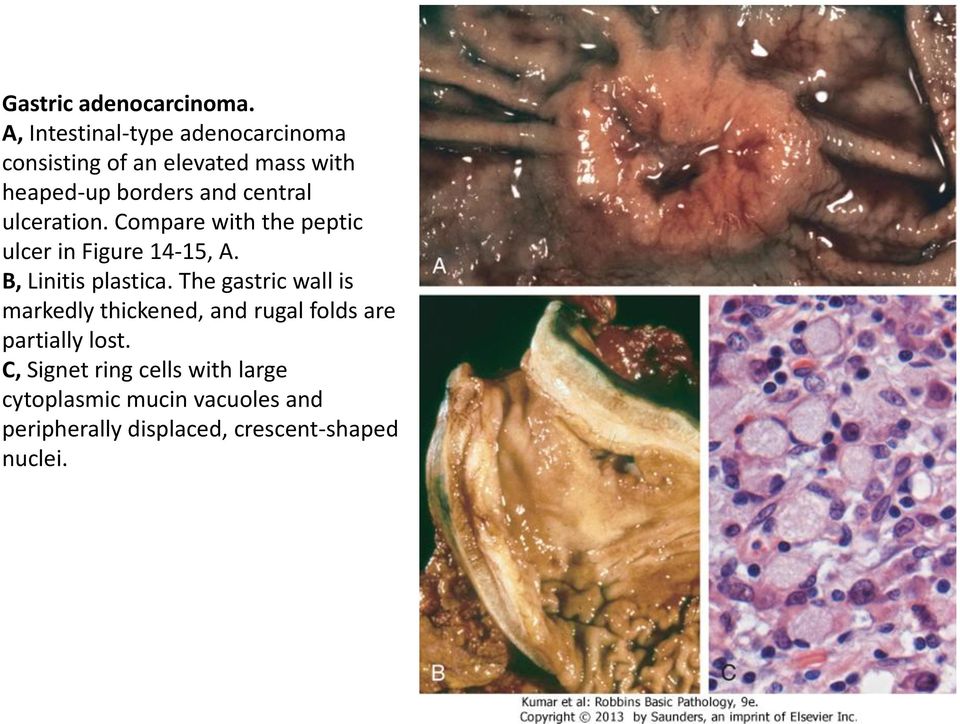 central ulceration. Compare with the peptic ulcer in Figure 14-15, A. B, Linitis plastica.