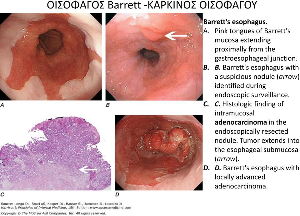 C. C. Histologic finding of intramucosal adenocarcinoma in the endoscopically resected nodule.