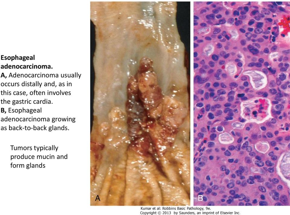 case, often involves the gastric cardia.