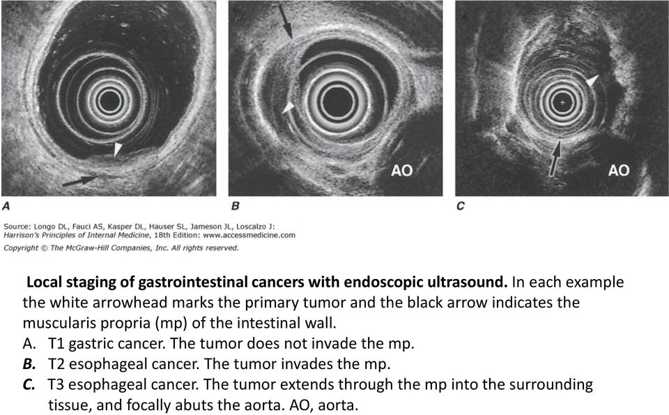 propria (mp) of the intestinal wall. A. T1 gastric cancer. The tumor does not invade the mp. B.