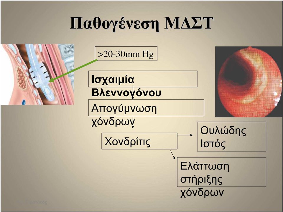 χόνδρων Χονδρίτις Ουλώδης Ιστός