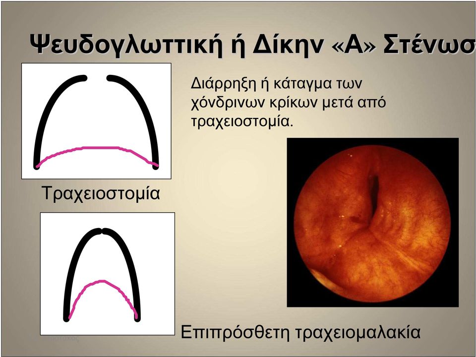 κρίκων µετά από τραχειοστοµία.