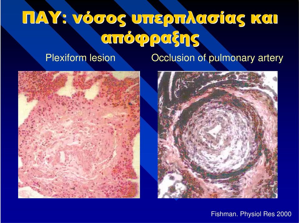 Occlusion of pulmonary