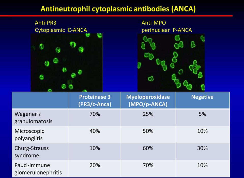 Churg-Strauss syndrome Pauci-immune glomerulonephritis Proteinase 3