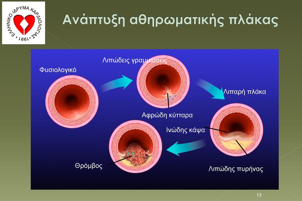 Αφρώδη κύτταρα Ινώδης