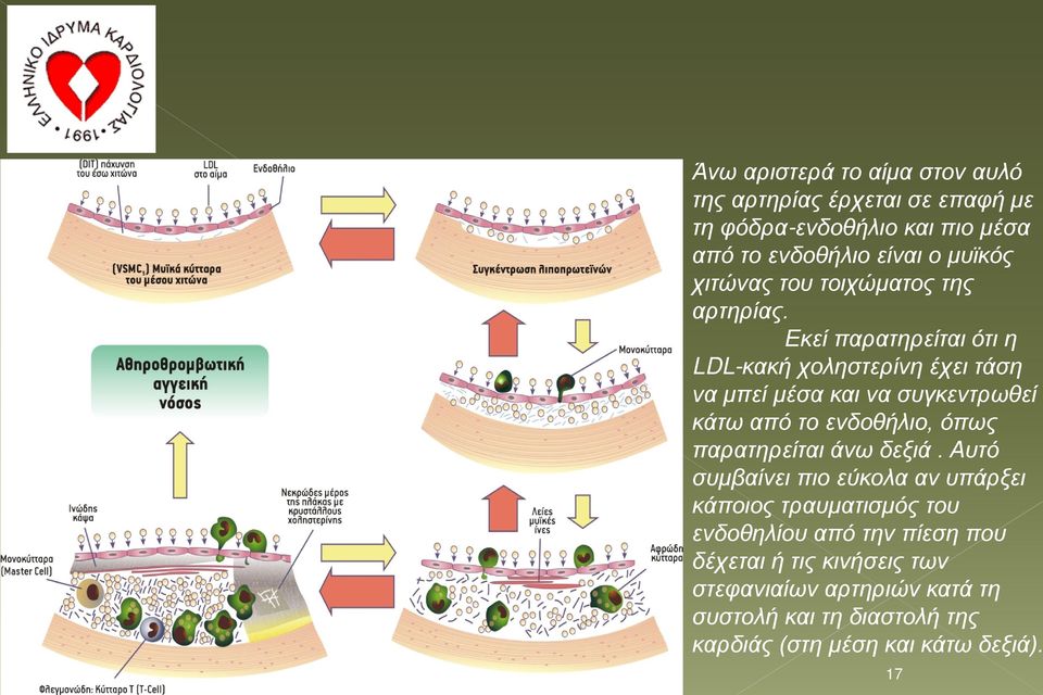Εκεί παρατηρείται ότι η LDL-κακή χοληστερίνη έχει τάση να μπεί μέσα και να συγκεντρωθεί κάτω από το ενδοθήλιο, όπως παρατηρείται