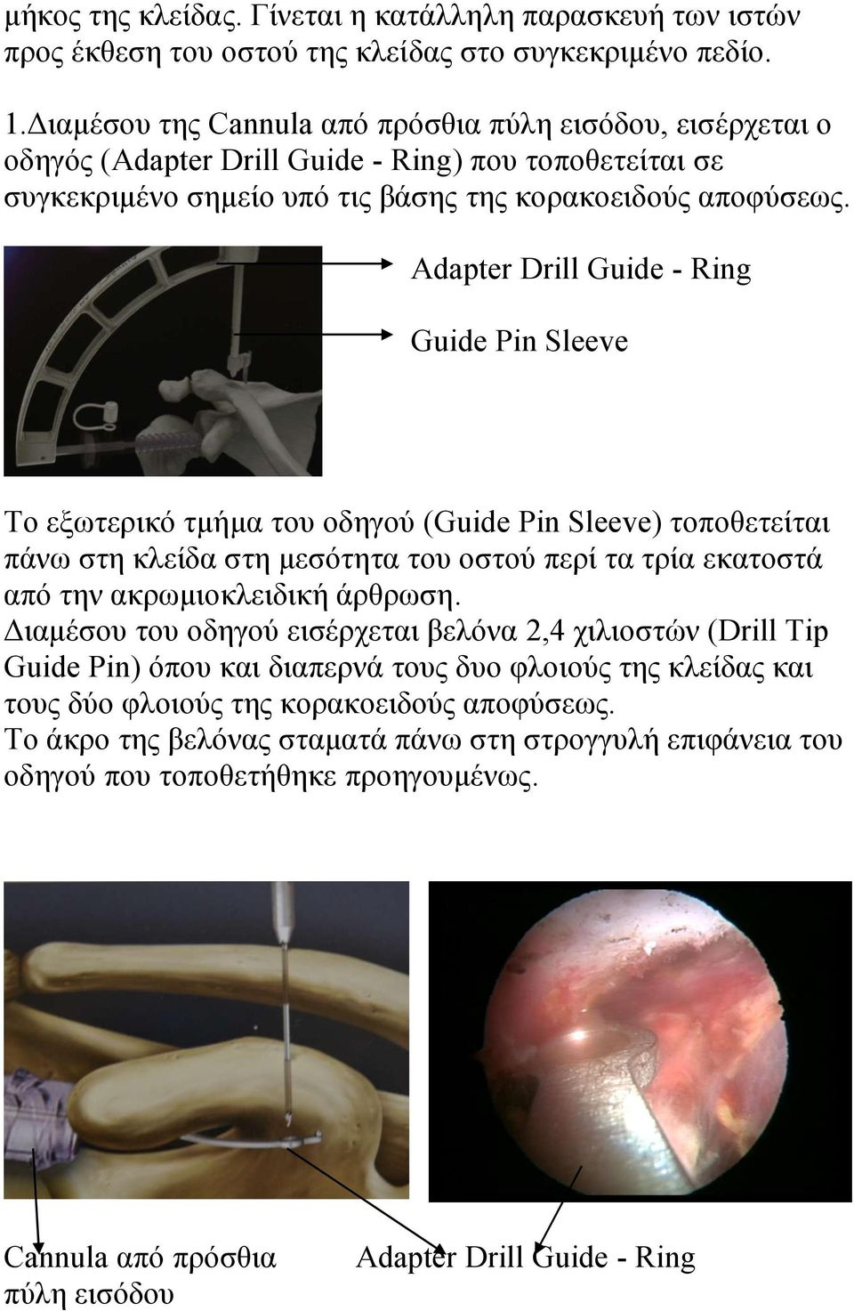 Adapter Drill Guide - Ring Guide Pin Sleeve Το εξωτερικό τμήμα του οδηγού (Guide Pin Sleeve) τοποθετείται πάνω στη κλείδα στη μεσότητα του οστού περί τα τρία εκατοστά από την ακρωμιοκλειδική άρθρωση.