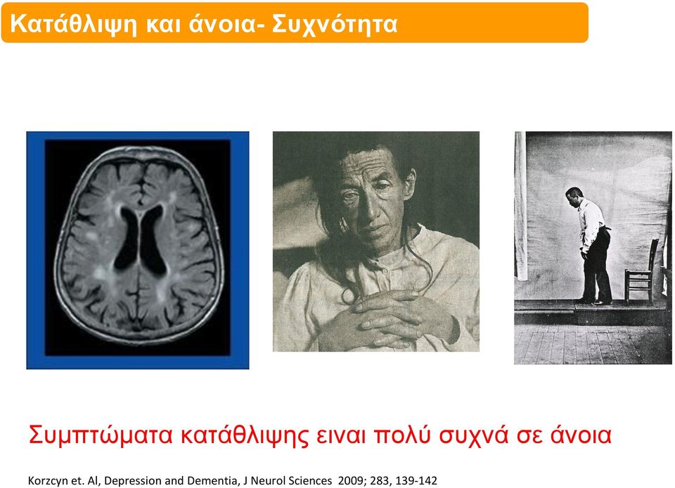 Neurol Sciences 2009; 283, 139-142