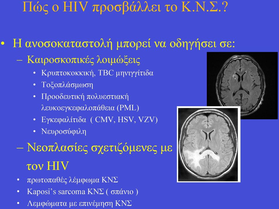 µηνιγγίτιδα Τοξοπλάσµωση Προοδευτική πολυεστιακή λευκοεγκεφαλοπάθεια (PML)