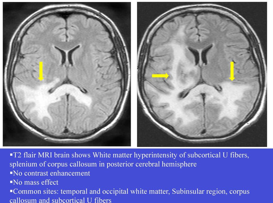 contrast enhancement No mass effect Common sites: temporal and