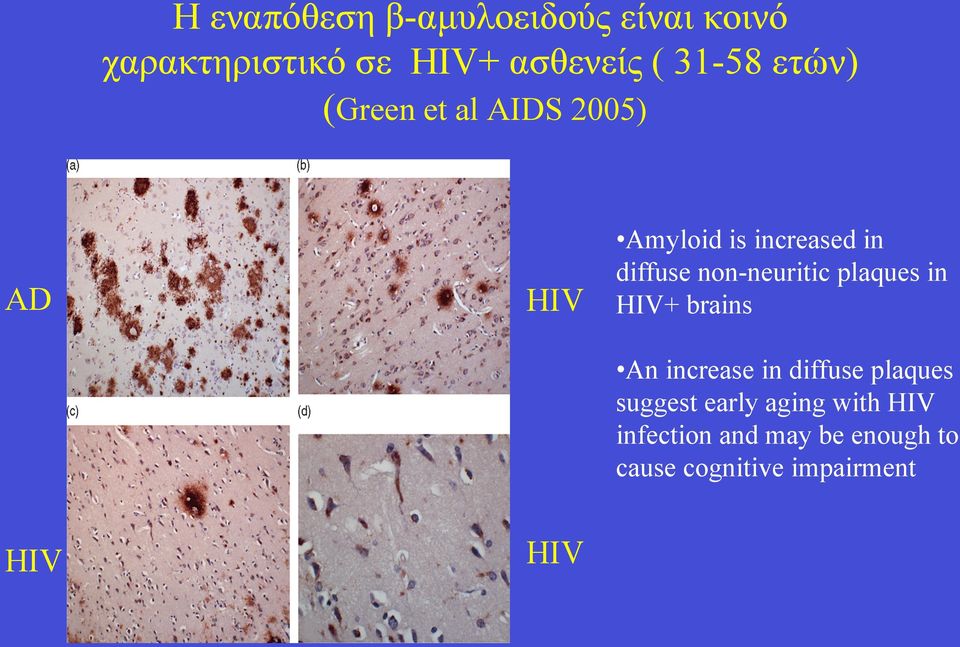 non-neuritic plaques in HIV+ brains An increase in diffuse plaques suggest