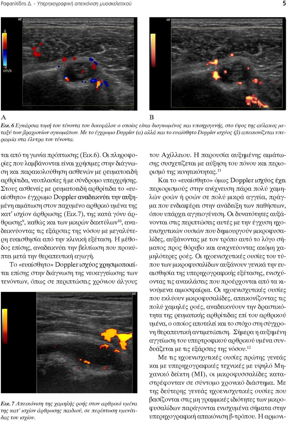 Με το έγχρωμο Doppler (α) αλλά και το ευαίσθητο Doppler ισχύος (β) απεικονίζεται υπεραιμία στα έλυτρα του τένοντα. ται από τη γωνία πρόπτωσης (Εικ.6.