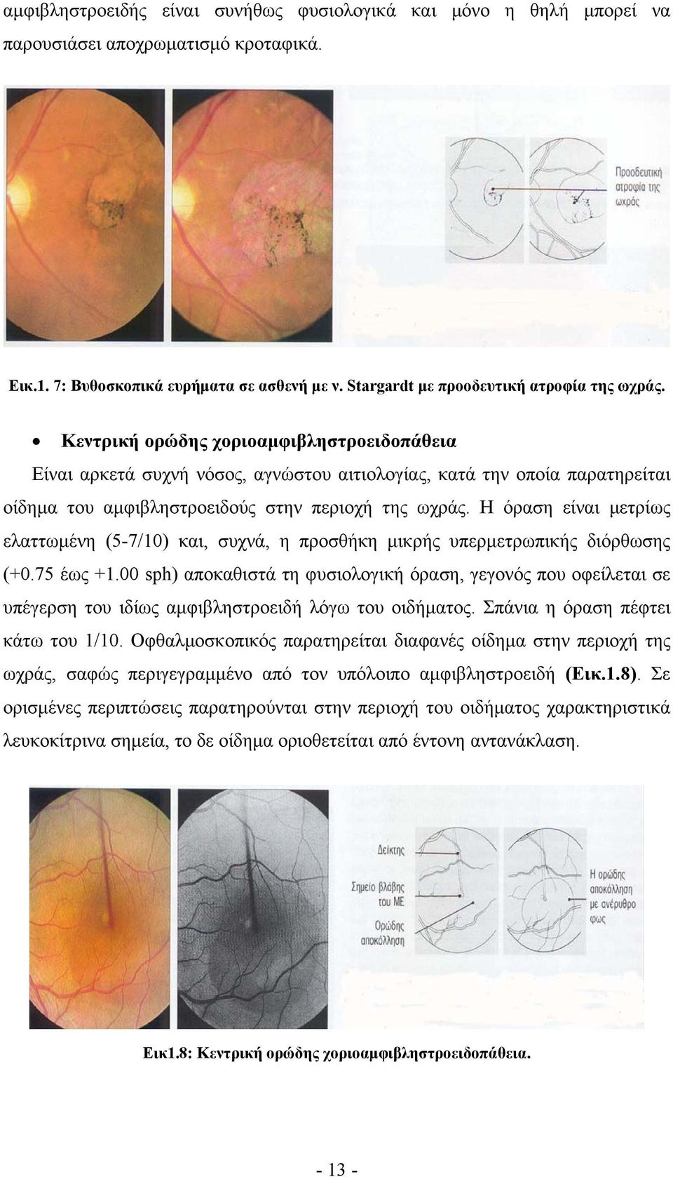 Η όραση είναι μετρίως ελαττωμένη (5-7/10) και, συχνά, η προσθήκη μικρής υπερμετρωπικής διόρθωσης (+0.75 έως +1.