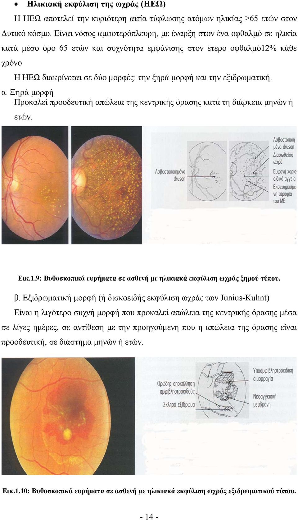 εξιδρωματική. α. Ξηρά μορφή Προκαλεί προοδευτική απώλεια της κεντρικής όρασης κατά τη διάρκεια μηνών ή ετών. Εικ.1.9: Βυθοσκοπικά ευρήματα σε ασθενή με ηλικιακά εκφύλιση ωχράς ξηρού τύπου. β.
