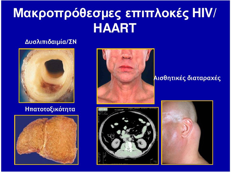 Δυσλιπιδαιμία/ΣΝ HAART