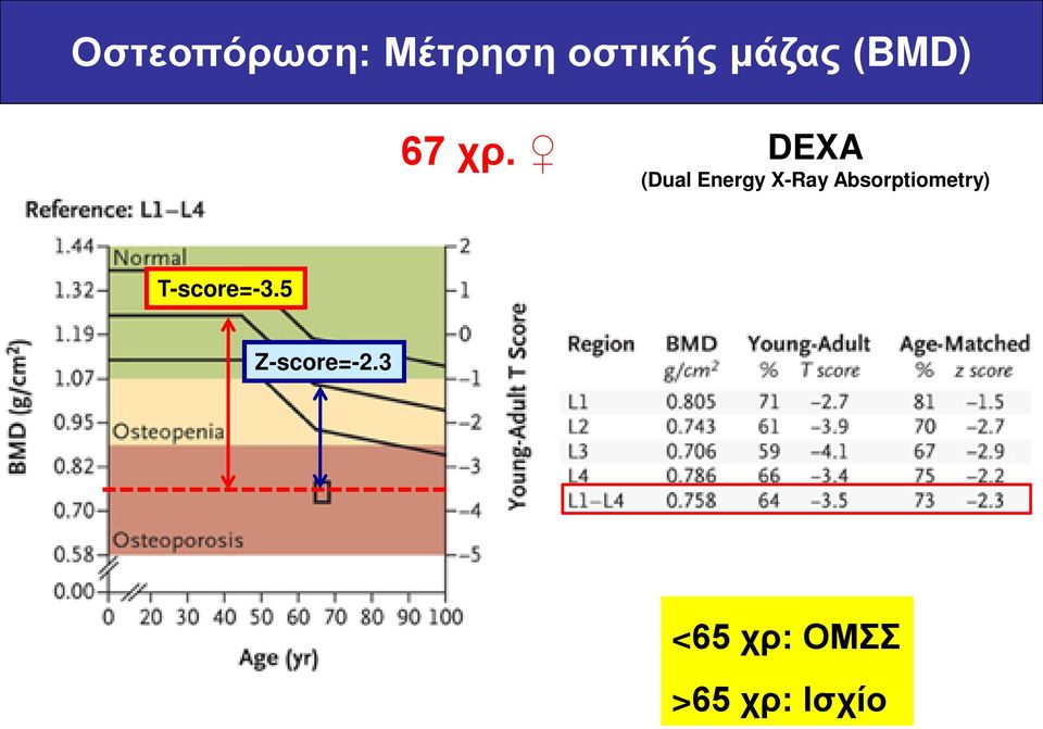 DEXA (Dual Energy X-Ray