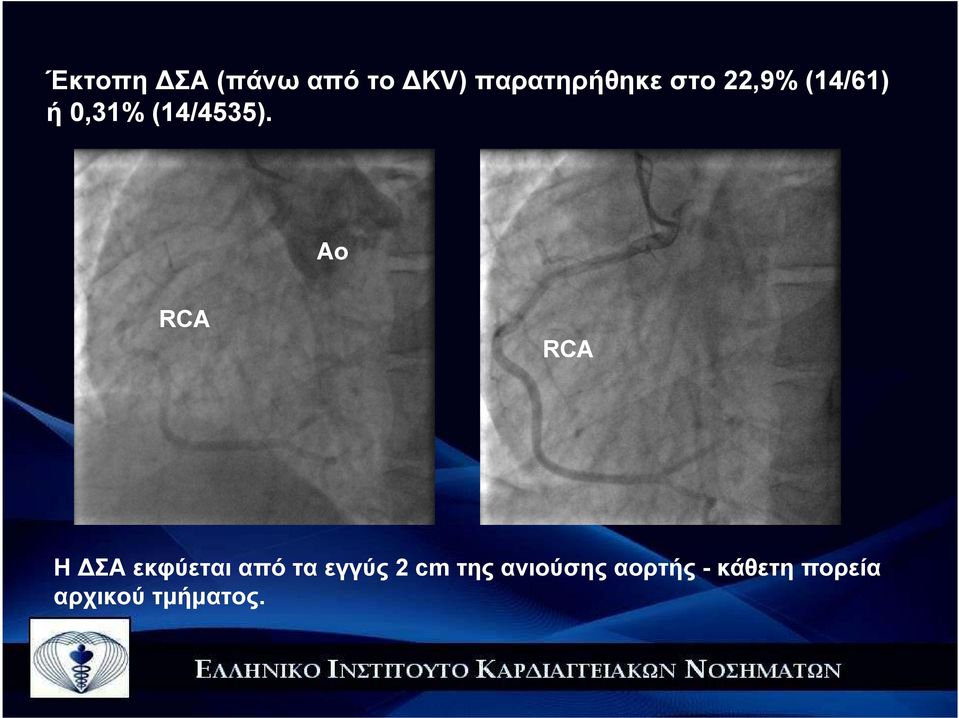 Αo RCA RCA Η ΣΑ εκφύεται από τα εγγύς 2 cm