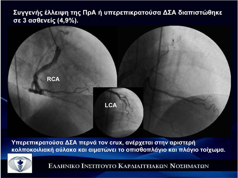 RCA LCA Υπερεπικρατούσα ΣΑ περνά τον crux, ανέρχεται