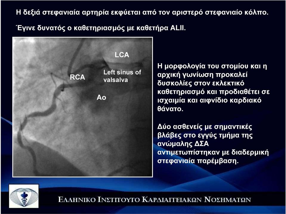 RCA Αo LCA Left sinus of valsalva Η µορφολογία του στοµίου και η αρχική γωνίωση προκαλεί δυσκολίες στον