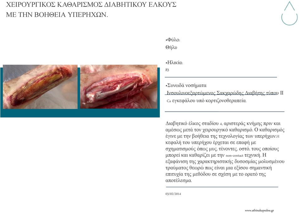 Διαβητικό έλκος σταδίου 4, αριστεράς κνήμης πριν και αμέσως μετά τον χειρουργικό καθαρισμό. Ο καθαρισμός έγινε με την βοήθεια της τεχνολογίας των υπερήχων.