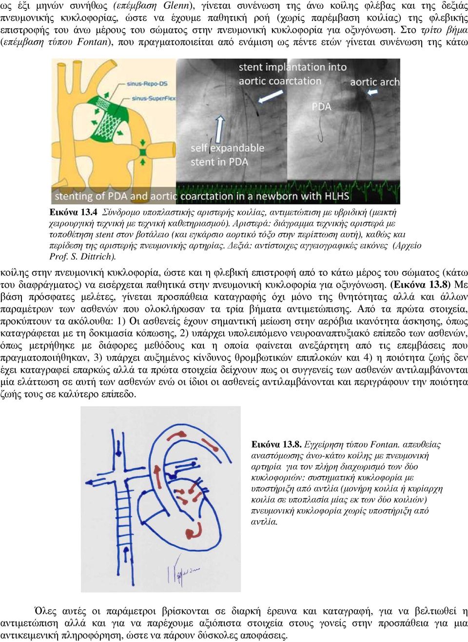 4 Σύνδροµο υποπλαστικής αριστερής κοιλίας, αντιµετώπιση µε υβριδική (µεικτή χειρουργική τεχνική µε τεχνική καθετηριασµού).