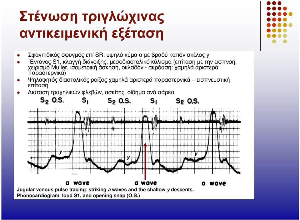 αριστερά παραστερνικά) Ψηλαφητός διαστολικός ροίζος χαµηλά αριστερά παραστερνικά εισπνευστική επίταση ιάταση τραχηλικών φλεβών,