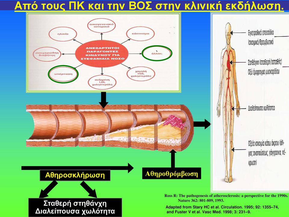 Αθηροσκλήρωση Αθηροθρόμβωση Σταθερή στηθάνχη Διαλείπουσα χωλότητα Ross R: The pathogenesis of