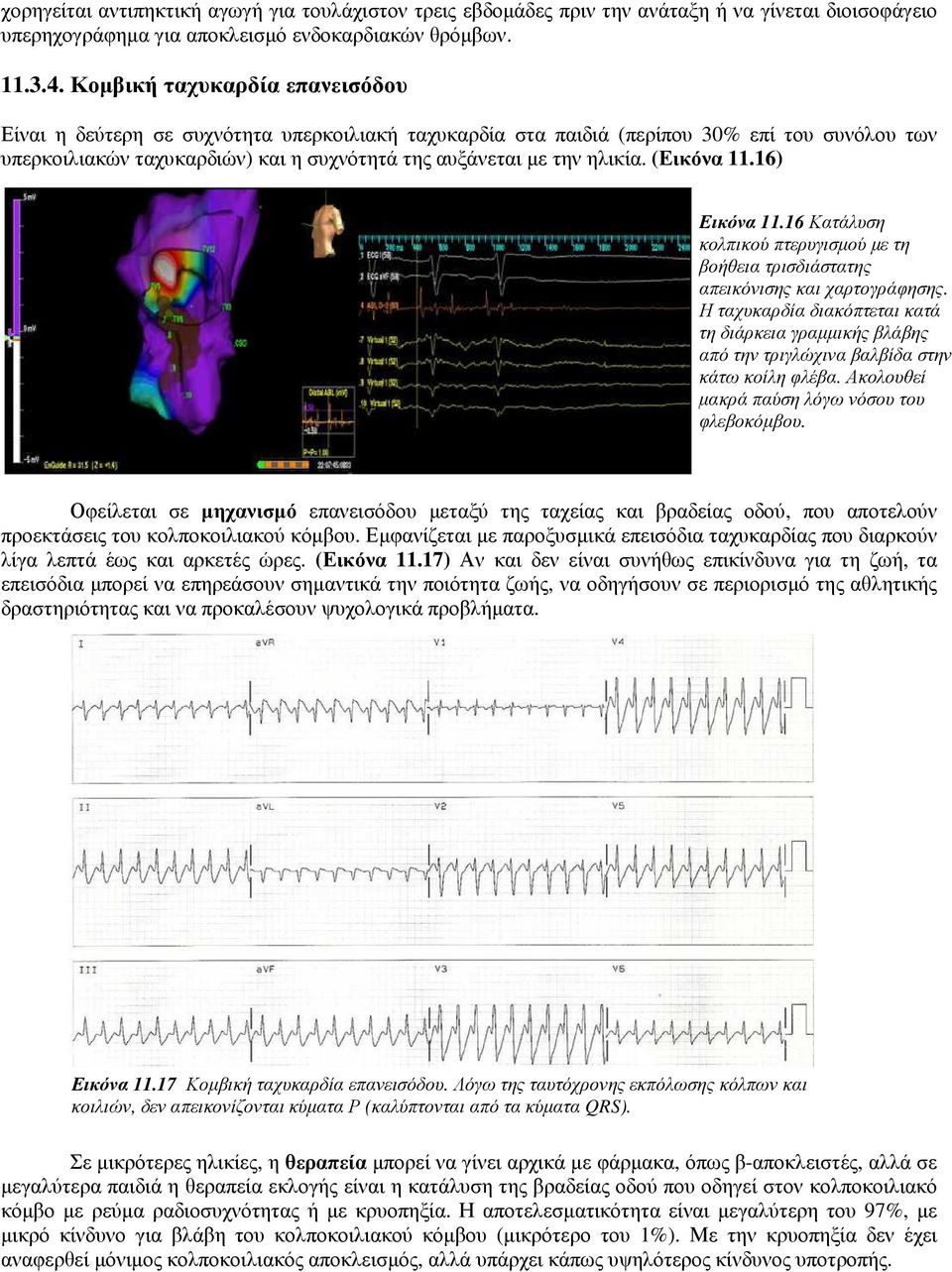 (Εικόνα 11.16) Εικόνα 11.16 Κατάλυση κολπικού πτερυγισµού µε τη βοήθεια τρισδιάστατης απεικόνισης και χαρτογράφησης.