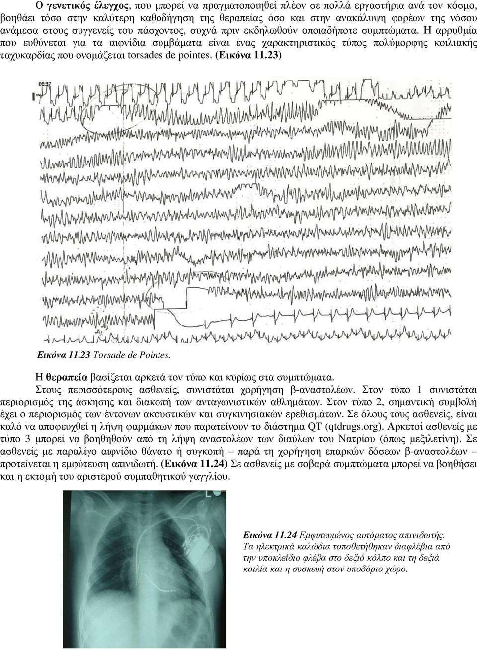 Η αρρυθµία που ευθύνεται για τα αιφνίδια συµβάµατα είναι ένας χαρακτηριστικός τύπος πολύµορφης κοιλιακής ταχυκαρδίας που ονοµάζεται torsades de pointes. (Εικόνα 11.23) Εικόνα 11.23 Τοrsade de Pointes.