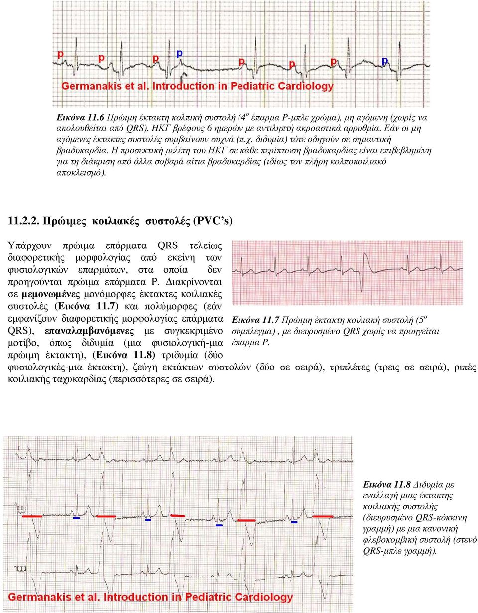 Η προσεκτική µελέτη του ΗΚΓ σε κάθε περίπτωση βραδυκαρδίας είναι επιβεβληµένη για τη διάκριση από άλλα σοβαρά αίτια βραδυκαρδίας (ιδίως τον πλήρη κολποκοιλιακό αποκλεισµό). 11.2.