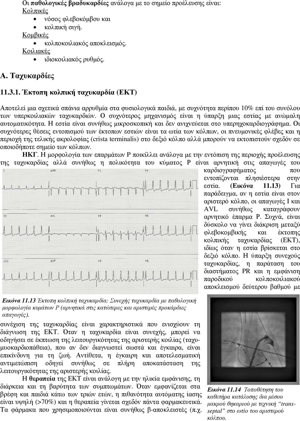 Ο συχνότερος µηχανισµός είναι η ύπαρξη µιας εστίας µε ανώµαλη αυτοµατικότητα. Η εστία είναι συνήθως µικροσκοπική και δεν ανιχνεύεται στο υπερηχοκαρδιογράφηµα.