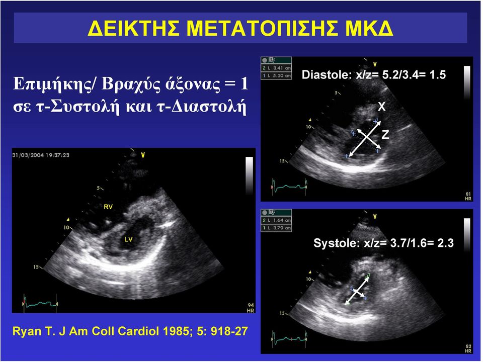 Diastole: x/z= 5.2/3.4= 1.